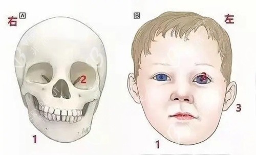 婴儿大小脸纠正图图片