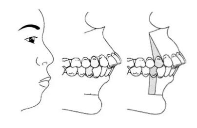 牙性凸嘴和骨性凸嘴的区别