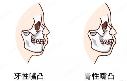 牙性凸嘴和骨性凸嘴卡通