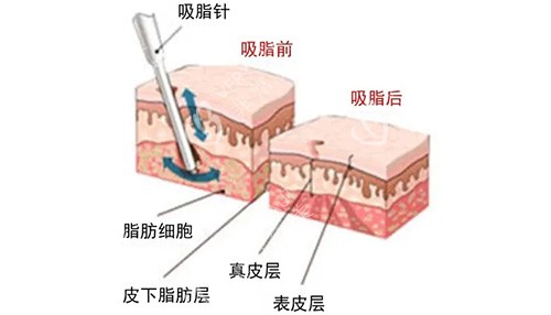 负压吸脂图示
