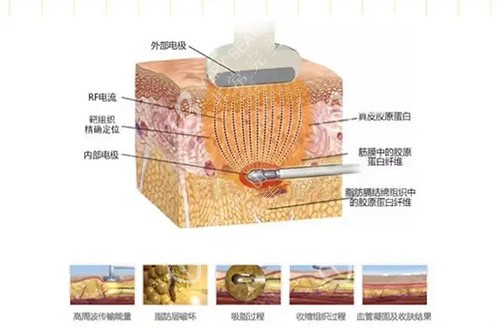 黄金微雕吸脂