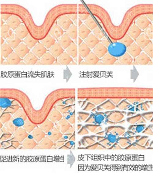 爱贝芙注射过程图