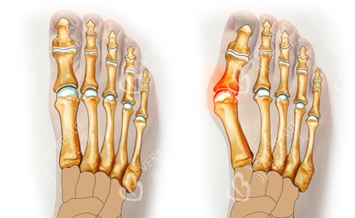武汉哪里可以做大脚骨手术这几家开展大脚骨手术有优势