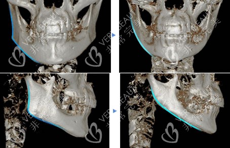 面部轮廓手术前后CT对比图