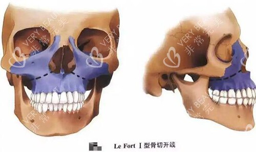 上颌Lefort l型截骨术
