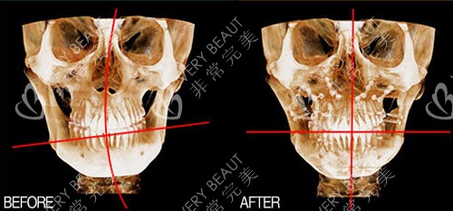 正颌手术前后CT对比图