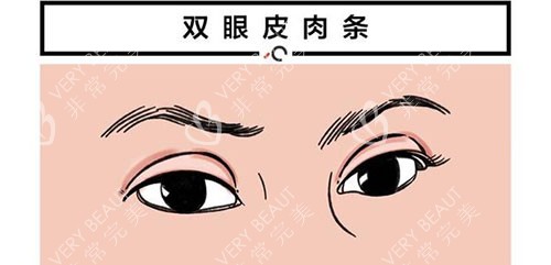 雙眼皮肉條示意圖