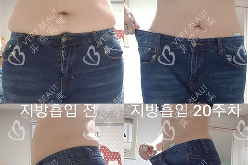 韩国365mc医院腹部吸脂前后照片