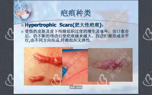 疤痕种类示意图