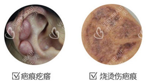 烧伤疤痕示意图