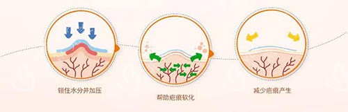 疤痕治疗示意图