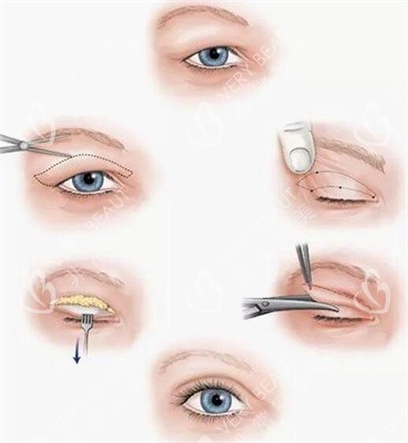 双眼皮手术过程图