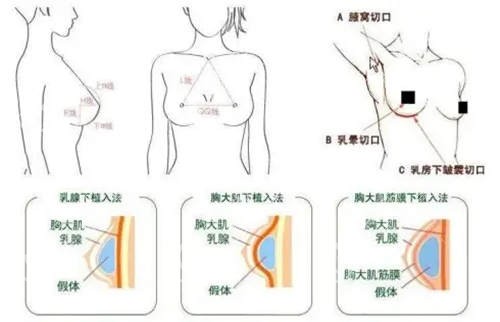 假体隆胸植入的位置