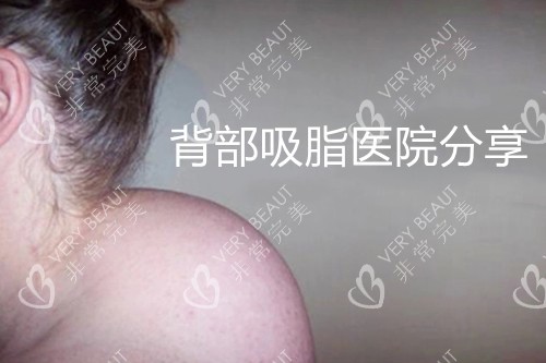 广东佛山背部吸脂医院分享！