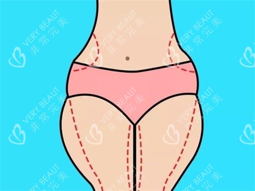 大腿吸脂示意图