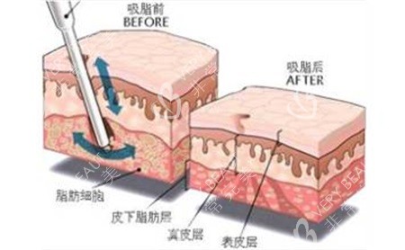 脂肪层示意图