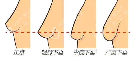 胸部下垂示意图