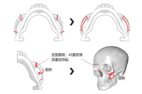 韩国WJ原辰整形颧骨手术