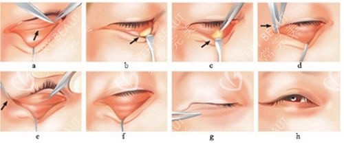 眼袋手术过程