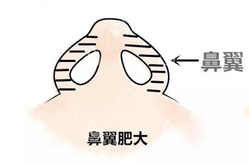 鼻翼肥大示意图