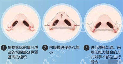 缩鼻翼手术过程