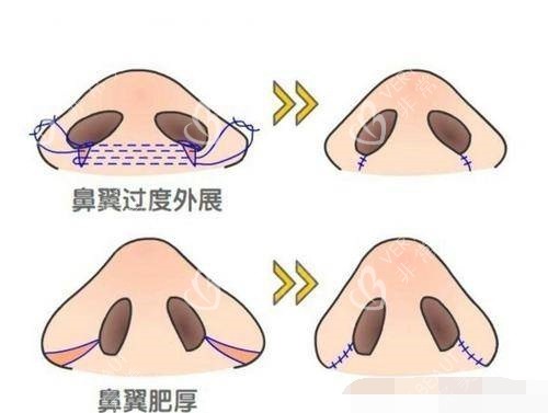 不同的鼻翼肥厚类型