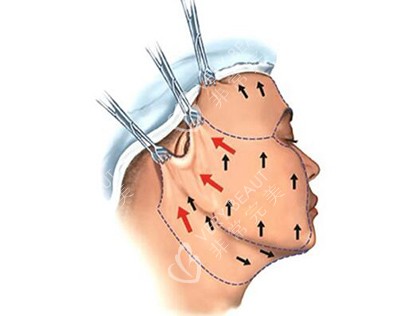 面部大拉皮手术