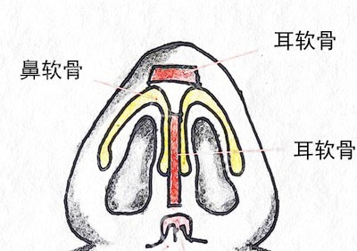医生隆鼻假体放置位置