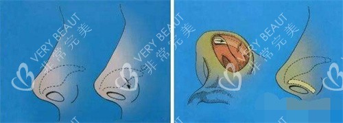 朝天鼻矫正示意图