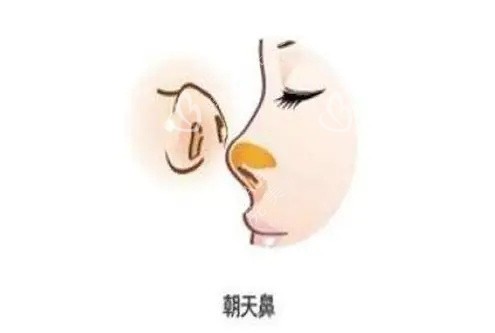 朝天鼻示意图