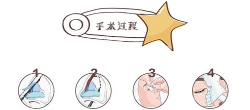隆鼻手术过程