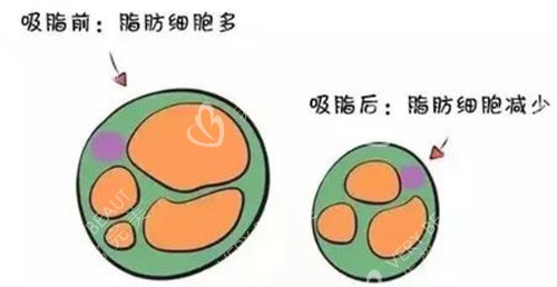 吸脂脂肪展示图照片