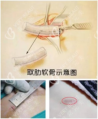 取肋软骨示意图