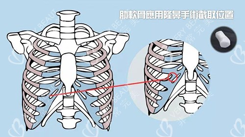肋软骨取材位置示意图