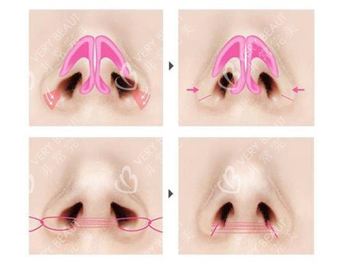 缩鼻翼风险大吗图片