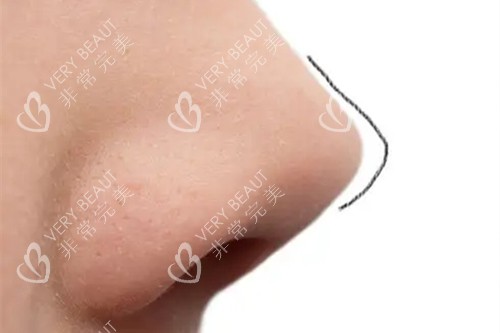 隆鼻手术鼻尖位置展示图