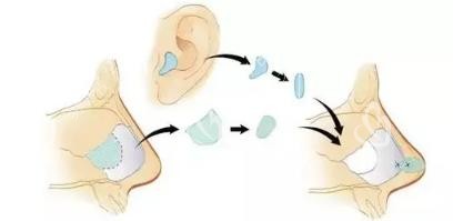 自体软骨隆鼻综合改善