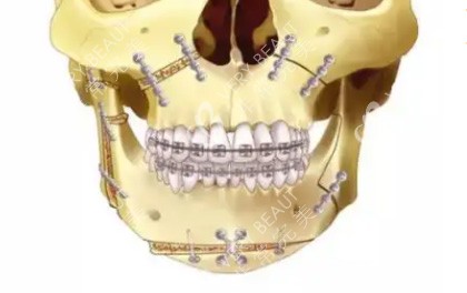 正颌手术固定方式图