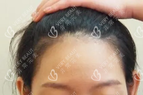 发际线种植示意图
