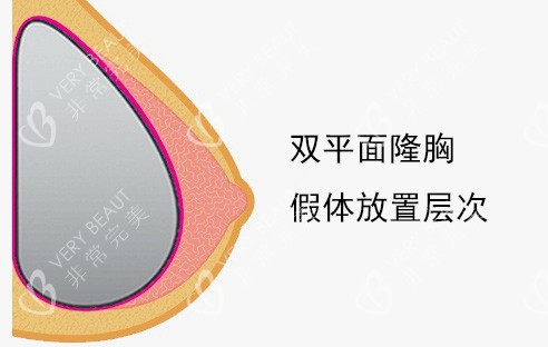 双平面隆胸假体放置层次