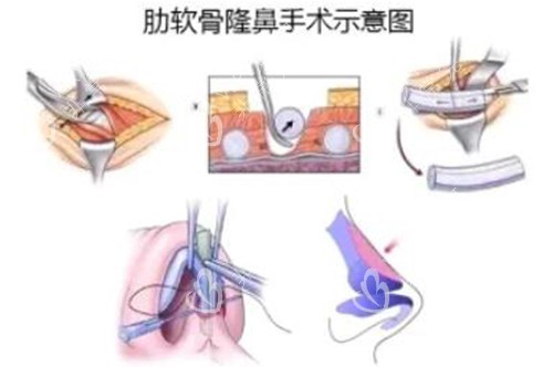 肋软骨鼻整形改善治疗