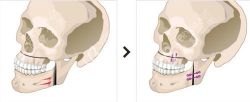 双鄂手术图片示意图