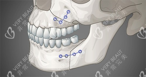 双鄂手术示意图