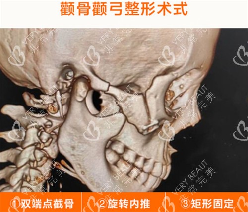 颧骨颧弓术式