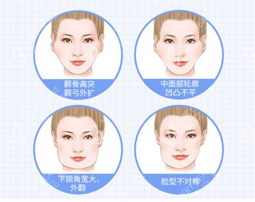 轮廓整形适应症