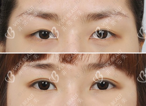 韩国ID整形医院双眼皮手术前后对比