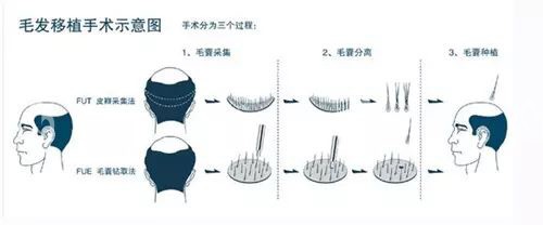 毛发移植手术示意图