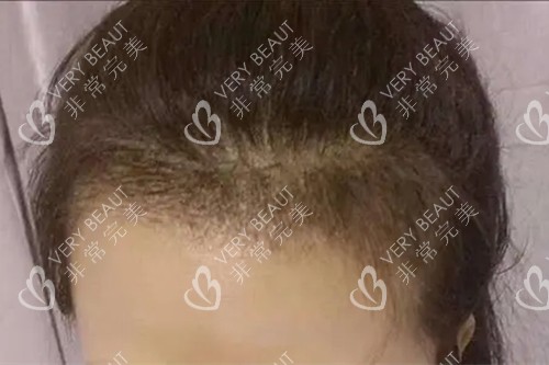 发际线种植示意图