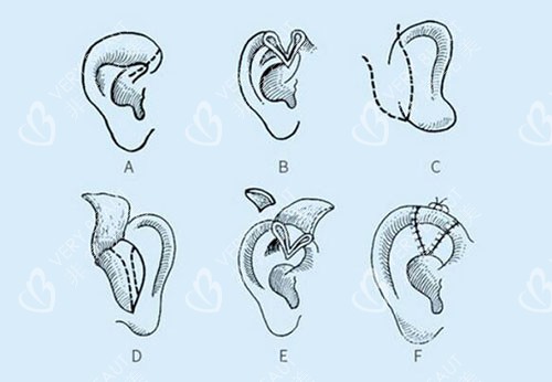 耳朵手术改善治疗展示图