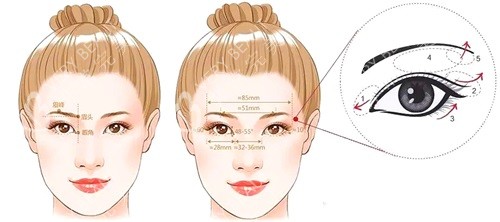 西安画美整形医院双眼皮示意图